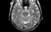 Posnetki MRI razkrili štiri edinstvene podtipe depresije