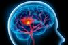 Teden možganov: Migrena šesta po vrsti med razlogi za bolniško odsotnost