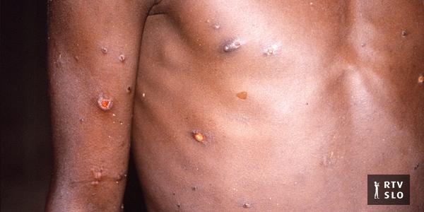 Les premiers cas d’infection par le virus de la variole du singe ont été confirmés dans de plus en plus de pays