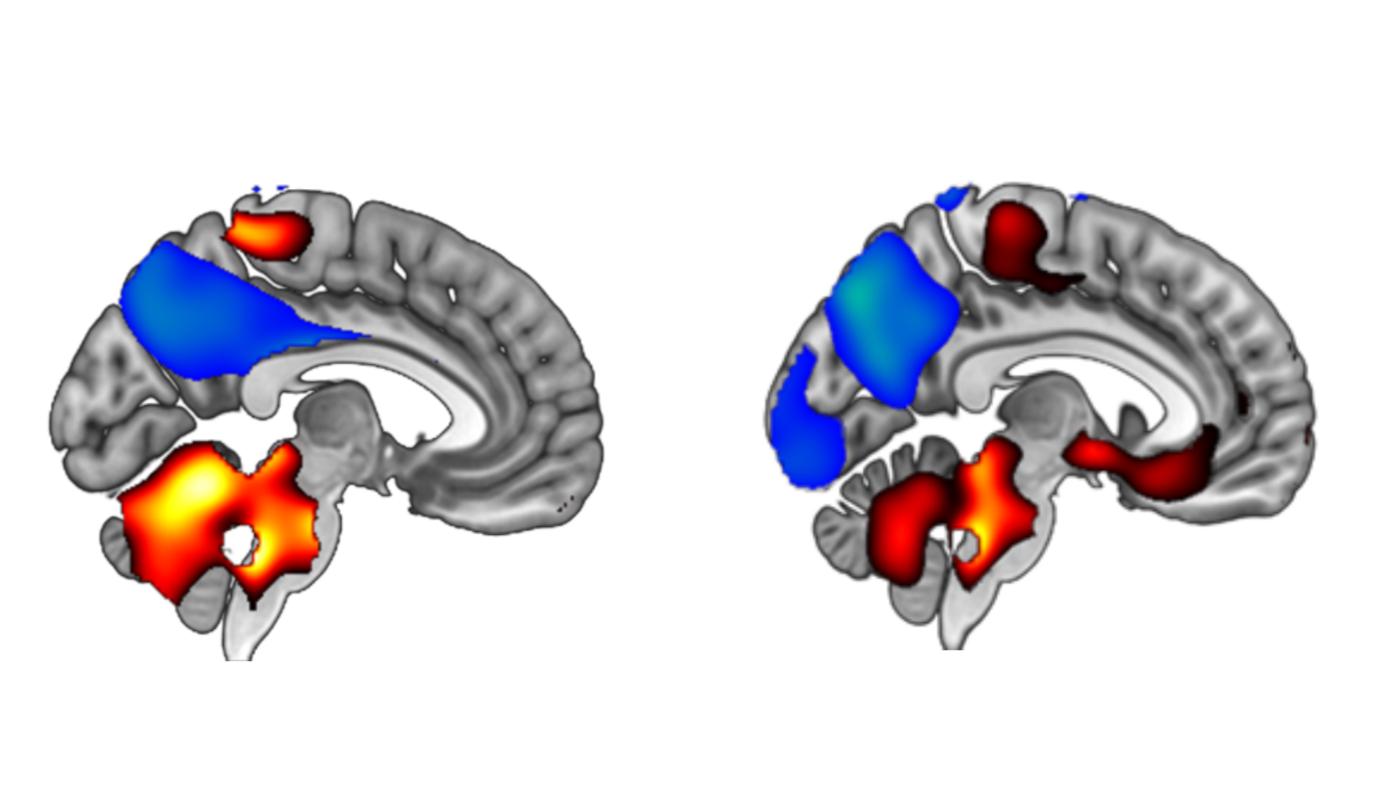 Prerez možganov, na katerem sta prikazana specifična presnovna vzorca pri Alzheimerjevi bolezni (levo) in demenci z Lewjevimi telesci (desno). Predeli z zmanjšano funkcijo so označeni z modro in se povezujejo s predeli z ohranjeno funkcijo, označenimi z rdečo. Raziskavi sta bili letos objavljeni v mednarodnih revijah. Foto: Osebni arhiv