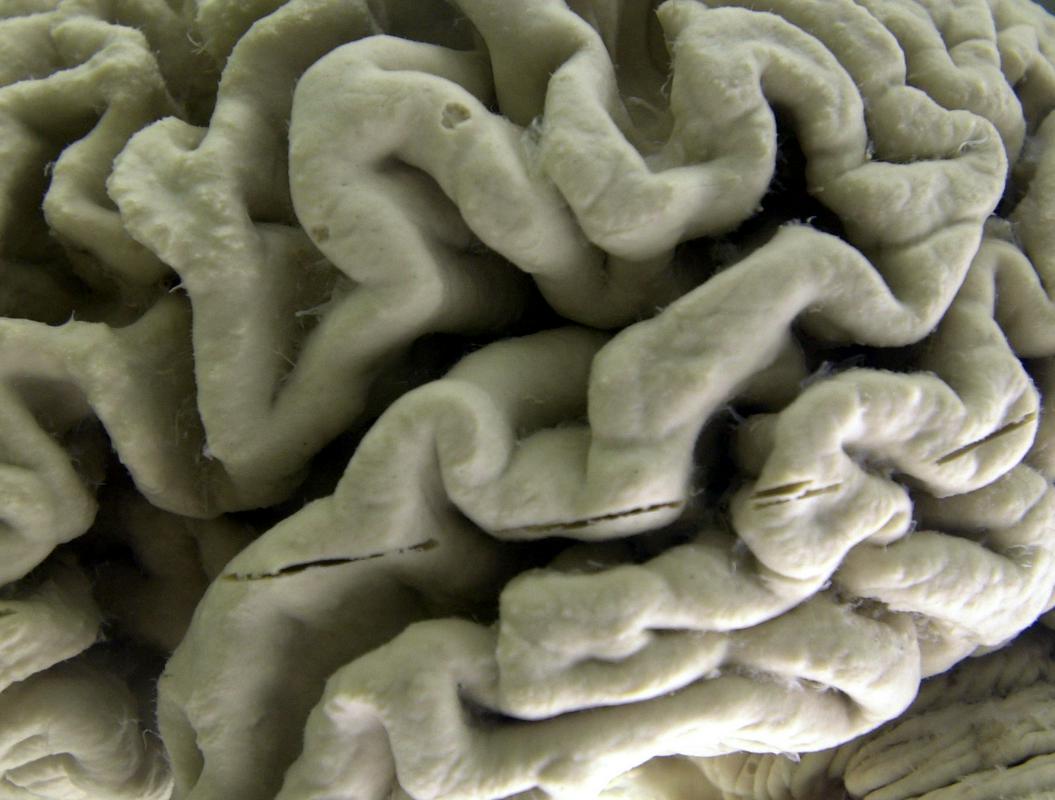 Prikaz možganov bolnika z Alzheimerjevo boleznijo. Foto: AP
