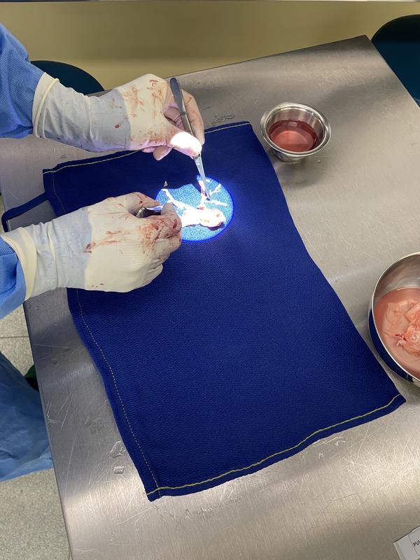 Operacijo izvajajo pri bolnikih, pri katerih zdravila ne raztopijo strdkov. Foto: UKC Ljubljana