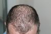 Bolezni kože: Alopecija