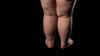 Kaj je lipedem? Ni le estetska težava na nogah, saj lahko poveča tveganje za vensko popuščanje.