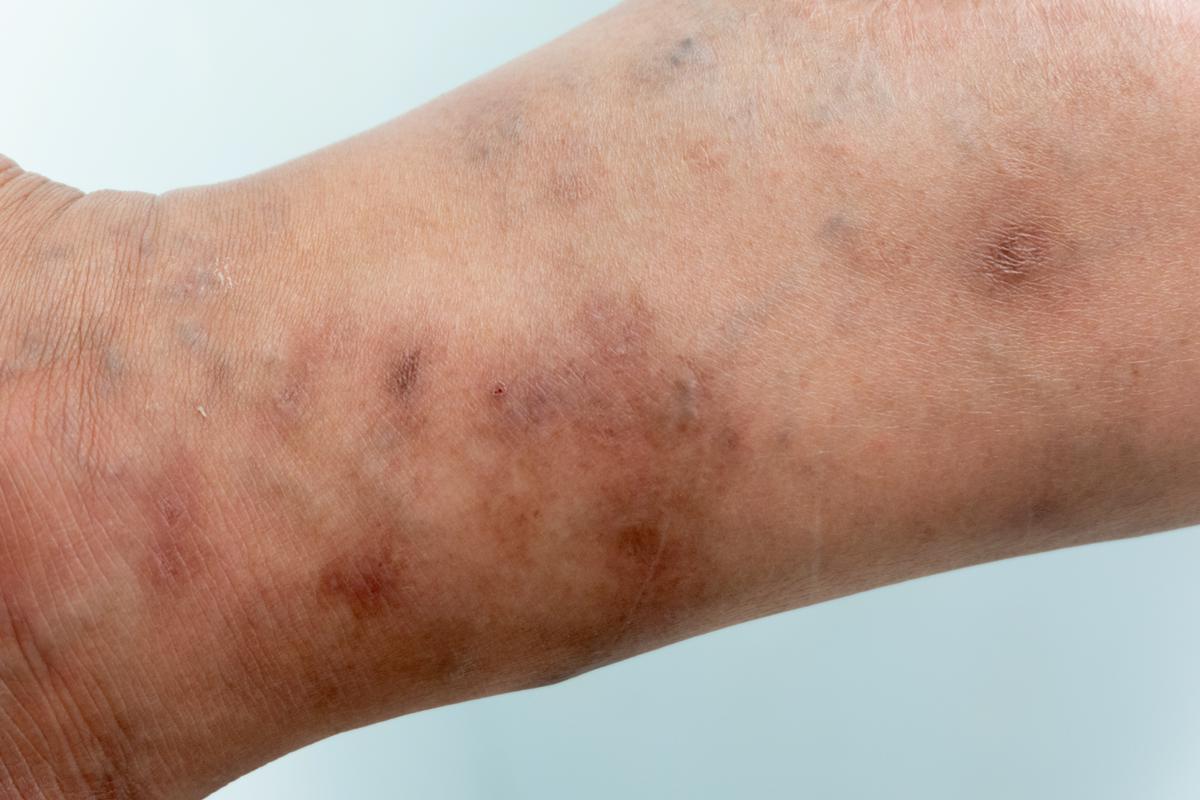 Okužbe z garjami so v zadnjih letih v precejšnjem porastu