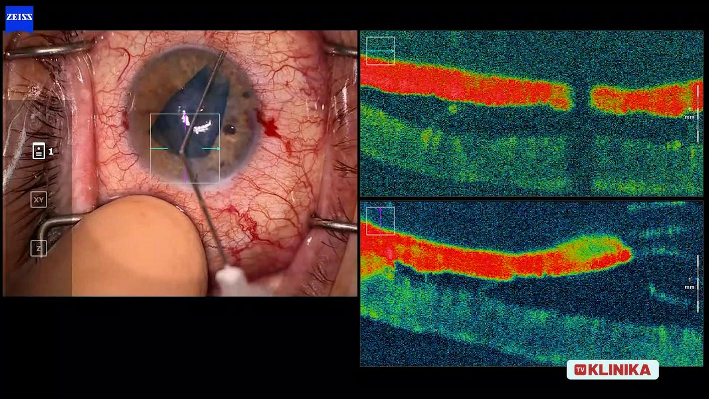 Z uspešno presaditvijo roženice so pacientki po petih letih povrnili vid