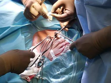 Bolnikom z obstruktivno spalno apnejo v Sloveniji na voljo najsodobnejša metoda zdravljenja