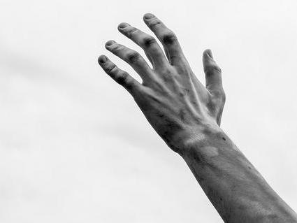 Vitiligo ni le estetska država, vpliva tudi na duševno zdravje, samopodobo in kakovost življenja