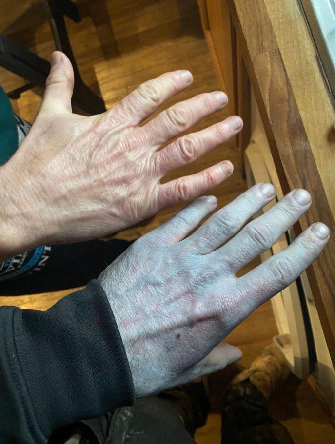 Zbudil se je povsem moder. Skrivnostno zdravstveno stanje? Ne, le neoprana posteljnina.