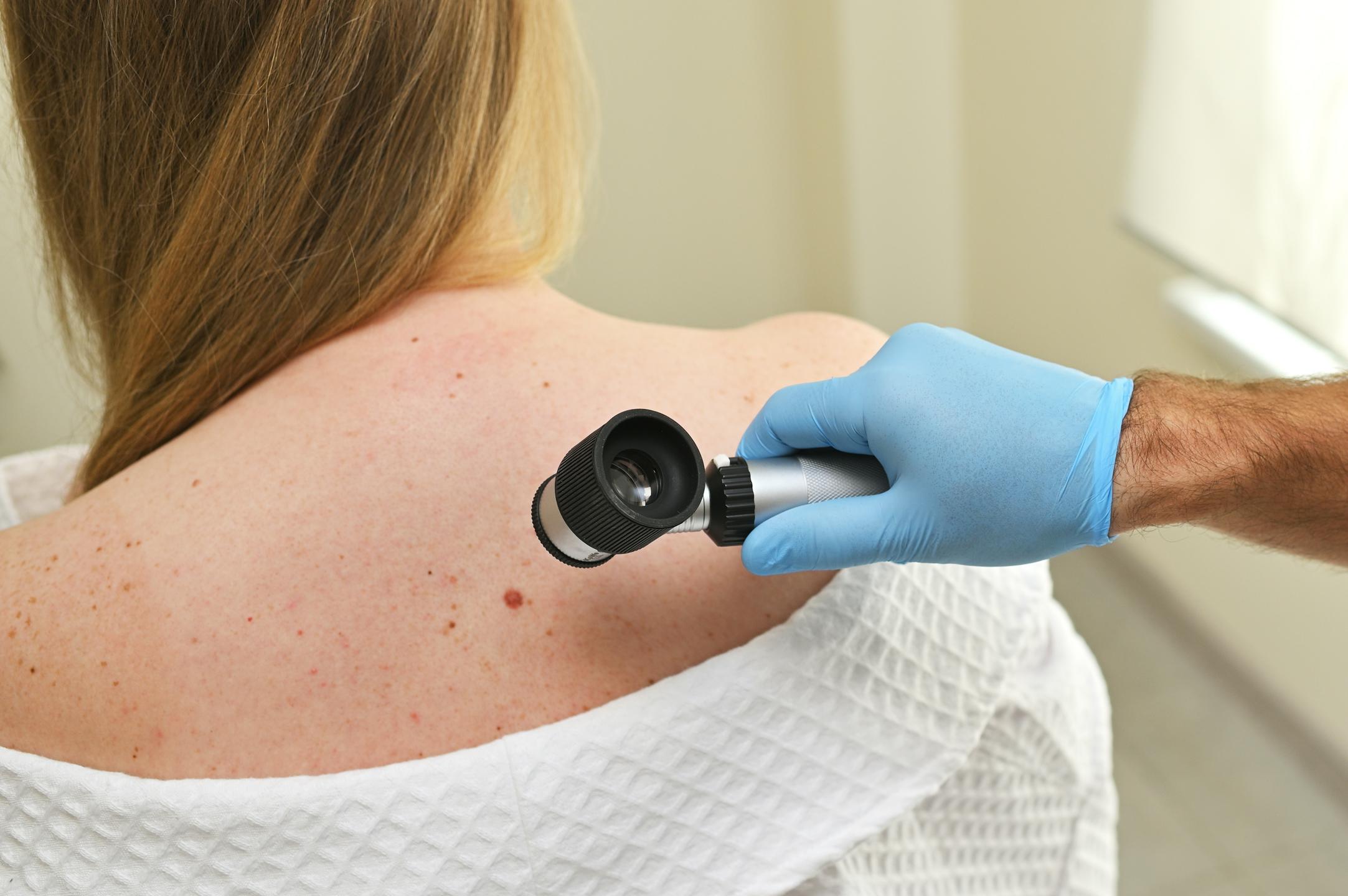 Ob dnevu boja proti kožnemu melanomu: Porjavelost kože ne predstavlja zdravja, temveč poškodbe